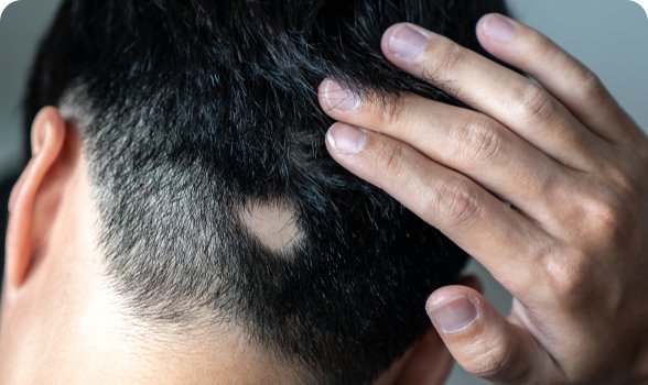 Alopecia Areata