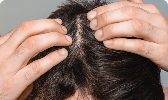 Dandruff & Scalp Detox