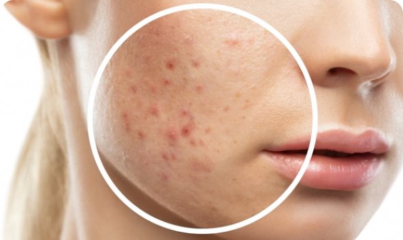 Acne, pigmentation