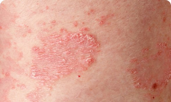 Psoriasis