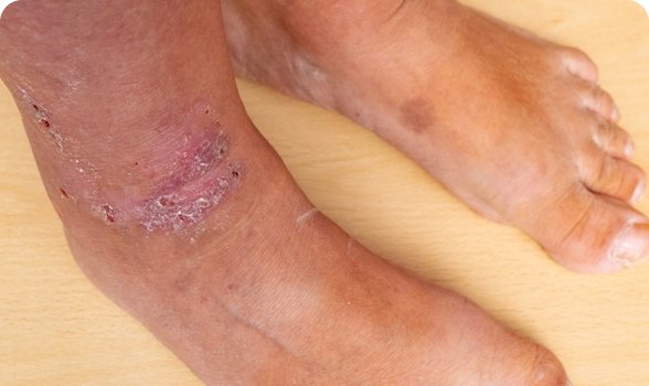 Ulcers (severe cases)