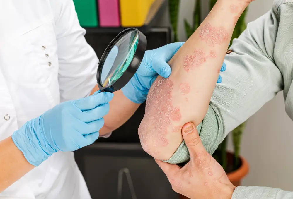 Psoriasis Control